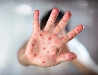 Angstmache vor der Kinderkrankheit Masern: Doch existiert das ach so 'gefährliche' Masernvirus überhaupt?