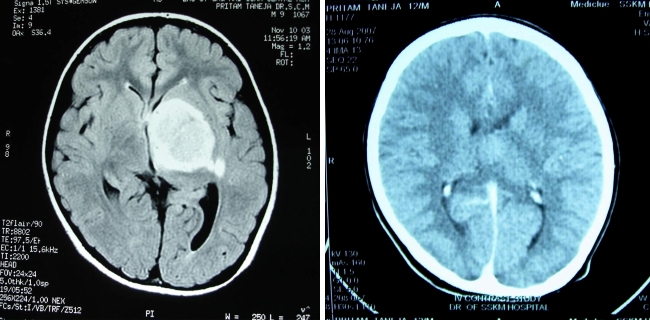 Ausgeheilter Gehirntumor (Astrozytom): MRT (Magnetresonanztomographie) vom 10.11.2003 (links). CT-Scan (Computertomographie) vom 28.8.2007 (rechts).