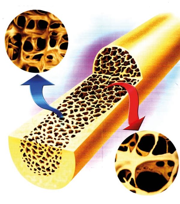 Vitamin K2 steuer die Kalziumablagerung im Knochen.